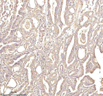 Immunohistochemical staining of PTCD1 using anti-PTCD1 antibody. PTCD1 was detected in a paraffin-embedded section of human thyroid papillary carcinoma tissue. Heat mediated antigen retrieval was performed in EDTA buffer (pH 8.0, epitope retrieval solution). The tissue section was blocked with 10% goat serum. The tissue section was then incubated with 2 ug/ml rabbit anti-PTCD1 antibody overnight at 4oC. Peroxidase Conjugated Goat Anti-rabbit IgG was used as secondary antibody and incubated for 30 minutes at 37oC. The tissue section was developed using an HRP secondary and DAB substrate.