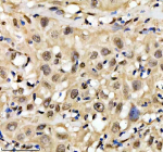 Immunohistochemical staining of QKI using anti-QKI antibody. QKI was detected in a paraffin-embedded section of human bladder cancer tissue. Heat mediated antigen retrieval was performed in EDTA buffer (pH 8.0, epitope retrieval solution). The tissue section was blocked with 10% goat serum. The tissue section was then incubated with 2 ug/ml rabbit anti-QKI antibody overnight at 4oC. Peroxidase Conjugated Goat Anti-rabbit IgG was used as secondary antibody and incubated for 30 minutes at 37oC. The tissue section was developed using an HRP secondary and DAB substrate.