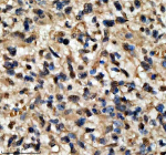 Immunohistochemical staining of QKI using anti-QKI antibody. QKI was detected in a paraffin-embedded section of human glioma tissue. Heat mediated antigen retrieval was performed in EDTA buffer (pH 8.0, epitope retrieval solution). The tissue section was blocked with 10% goat serum. The tissue section was then incubated with 2 ug/ml rabbit anti-QKI antibody overnight at 4oC. Peroxidase Conjugated Goat Anti-rabbit IgG was used as secondary antibody and incubated for 30 minutes at 37oC. The tissue section was developed using an HRP secondary and DAB substrate.