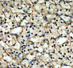 Immunohistochemical staining of QKI using anti-QKI antibody. QKI was detected in a paraffin-embedded section of human renal cancer tissue. Heat mediated antigen retrieval was performed in EDTA buffer (pH 8.0, epitope retrieval solution). The tissue section was blocked with 10% goat serum. The tissue section was then incubated with 2 ug/ml rabbit anti-QKI antibody overnight at 4oC. Peroxidase Conjugated Goat Anti-rabbit IgG was used as secondary antibody and incubated for 30 minutes at 37oC. The tissue section was developed using an HRP secondary and DAB substrate.