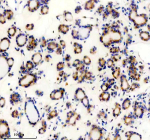 Immunohistochemical staining of TENM2 using anti-TENM2 antibody. TENM2 was detected in a paraffin-embedded section of human thyroid cancer tissue. Heat mediated antigen retrieval was performed in EDTA buffer (pH 8.0, epitope retrieval solution). The tissue section was blocked with 10% goat serum. The tissue section was then incubated with 2 ug/ml rabbit anti-TENM2 antibody overnight at 4oC. Peroxidase Conjugated Goat Anti-rabbit IgG was used as secondary antibody and incubated for 30 minutes at 37oC. The tissue section was developed using an HRP secondary and DAB substrate.