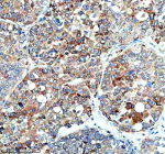 Immunohistochemical staining of HERC4 using anti-HERC4 antibody. HERC4 was detected in a paraffin-embedded section of human liver cancer tissue. Heat mediated antigen retrieval was performed in EDTA buffer (pH 8.0, epitope retrieval solution). The tissue section was blocked with 10% goat serum. The tissue section was then incubated with 2 ug/ml rabbit anti-HERC4 antibody overnight at 4oC. Peroxidase Conjugated Goat Anti-rabbit IgG was used as secondary antibody and incubated for 30 minutes at 37oC. The tissue section was developed using an HRP secondary and DAB substrate.