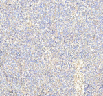 Immunohistochemical staining of Annexin using anti-Annexin antibody. Annexin was detected in a paraffin-embedded section of human non-small cell lung cancer tissue. Heat mediated antigen retrieval was performed in EDTA buffer (pH 8.0, epitope retrieval solution). The tissue section was blocked with 10% goat serum. The tissue section was then incubated with 2 ug/ml rabbit anti-Annexin antibody overnight at 4oC. Peroxidase Conjugated Goat Anti-rabbit IgG was used as secondary antibody and incubated for 30 minutes at 37oC. The tissue section was developed using an HRP secondary and DAB substrate.