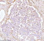 Immunohistochemical staining of GNAI2 using anti-GNAI2 antibody. GNAI2 was detected in a paraffin-embedded section of human liver cancer tissue. Heat mediated antigen retrieval was performed in EDTA buffer (pH 8.0, epitope retrieval solution). The tissue section was blocked with 10% goat serum. The tissue section was then incubated with 2 ug/ml rabbit anti-GNAI2 antibody overnight at 4oC. Peroxidase Conjugated Goat Anti-rabbit IgG was used as secondary antibody and incubated for 30 minutes at 37oC. The tissue section was developed using an HRP secondary and DAB substrate.