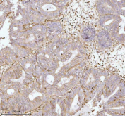 Immunohistochemical staining of GNAI2 using anti-GNAI2 antibody. GNAI2 was detected in a paraffin-embedded section of human endometrioid adenocarcinoma tissue. Heat mediated antigen retrieval was performed in EDTA buffer (pH 8.0, epitope retrieval solution). The tissue section was blocked with 10% goat serum. The tissue section was then incubated with 2 ug/ml rabbit anti-GNAI2 antibody overnight at 4oC. Peroxidase Conjugated Goat Anti-rabbit IgG was used as secondary antibody and incubated for 30 minutes at 37oC. The tissue section was developed using an HRP secondary and DAB substrate.