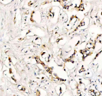 Immunohistochemical staining of SYNJ2 using anti-SYNJ2 antibody. SYNJ2 was detected in a paraffin-embedded section of human breast cancer tissue. Heat mediated antigen retrieval was performed in EDTA buffer (pH 8.0, epitope retrieval solution). The tissue section was blocked with 10% goat serum. The tissue section was then incubated with 2 ug/ml rabbit anti-SYNJ2 antibody overnight at 4oC. Peroxidase Conjugated Goat Anti-rabbit IgG was used as secondary antibody and incubated for 30 minutes at 37oC. The tissue section was developed using an HRP secondary and DAB substrate.