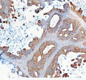 Immunohistochemical staining of SYNJ2 using anti-SYNJ2 antibody. SYNJ2 was detected in a paraffin-embedded section of human ovarian cancer tissue. Heat mediated antigen retrieval was performed in EDTA buffer (pH 8.0, epitope retrieval solution). The tissue section was blocked with 10% goat serum. The tissue section was then incubated with 2 ug/ml rabbit anti-SYNJ2 antibody overnight at 4oC. Peroxidase Conjugated Goat Anti-rabbit IgG was used as secondary antibody and incubated for 30 minutes at 37oC. The tissue section was developed using an HRP secondary and DAB substrate.