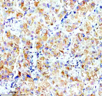 Immunohistochemical staining of OPN5 using anti-OPN5 antibody. OPN5 was detected in a paraffin-embedded section of human liver cancer tissue. Heat mediated antigen retrieval was performed in EDTA buffer (pH 8.0, epitope retrieval solution). The tissue section was blocked with 10% goat serum. The tissue section was then incubated with 2 ug/ml rabbit anti-OPN5 antibody overnight at 4oC. Peroxidase Conjugated Goat Anti-rabbit IgG was used as secondary antibody and incubated for 30 minutes at 37oC. The tissue section was developed using an HRP secondary and DAB substrate.