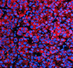 Immunofluorescent staining of OPN5 using anti-OPN5 antibody. OPN5 was detected in a paraffin-embedded section of human liver cancer tissue. Heat mediated antigen retrieval was performed in EDTA buffer (pH 8.0, epitope retrieval solution). The tissue section was blocked with 10% goat serum. The tissue section was then incubated with 5 ug/ml rabbit anti-OPN5 antibody overnight at 4oC. Cy3 Conjugated Goat Anti-Rabbit IgG was used as secondary antibody at 1:500 dilution and incubated for 30 minutes at 37oC. The section was counterstained with DAPI nuclear stain (blue). Visualize using a fluorescence microscope and filter sets appropriate for the label used.