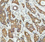 Immunohistochemical staining of MAPK14 using anti- MAPK14 antibody. MAPK14 was detected in a paraffin-embedded section of human breast cancer tissue. Heat mediated antigen retrieval was performed in EDTA buffer (pH 8.0, epitope retrieval solution). The tissue section was blocked with 10% goat serum. The tissue section was then incubated with 2 ug/ml rabbit anti- MAPK14 antibody overnight at 4oC. Peroxidase Conjugated Goat Anti-rabbit IgG was used as secondary antibody and incubated for 30 minutes at 37oC. The tissue section was developed using an HRP secondary and DAB substrate.