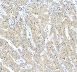 Immunohistochemical staining of SERPINA12 using anti-SERPINA12 antibody. SERPINA12 was detected in a paraffin-embedded section of human liver cancer tissue. Heat mediated antigen retrieval was performed in EDTA buffer (pH 8.0, epitope retrieval solution). The tissue section was blocked with 10% goat serum. The tissue section was then incubated with 2 ug/ml rabbit anti-SERPINA12 antibody overnight at 4oC. Peroxidase Conjugated Goat Anti-rabbit IgG was used as secondary antibody and incubated for 30 minutes at 37oC. The tissue section was developed using an HRP secondary and DAB substrate.