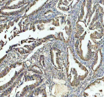 Immunohistochemical staining of PSME3 using anti-PSME3 antibody. PSME3 was detected in a paraffin-embedded section of human colon cancer tissue. Heat mediated antigen retrieval was performed in EDTA buffer (pH 8.0, epitope retrieval solution). The tissue section was blocked with 10% goat serum. The tissue section was then incubated with 2 ug/ml rabbit anti-PSME3 antibody overnight at 4oC. Peroxidase Conjugated Goat Anti-rabbit IgG was used as secondary antibody and incubated for 30 minutes at 37oC. The tissue section was developed using an HRP secondary and DAB substrate.