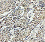 Immunohistochemical staining of PSME3 using anti-PSME3 antibody. PSME3 was detected in a paraffin-embedded section of human cervical cancer tissue. Heat mediated antigen retrieval was performed in EDTA buffer (pH 8.0, epitope retrieval solution). The tissue section was blocked with 10% goat serum. The tissue section was then incubated with 2 ug/ml rabbit anti-PSME3 antibody overnight at 4oC. Peroxidase Conjugated Goat Anti-rabbit IgG was used as secondary antibody and incubated for 30 minutes at 37oC. The tissue section was developed using an HRP secondary and DAB substrate.