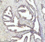 Immunohistochemical staining of NDUFA1 using anti-NDUFA1 antibody. NDUFA1 was detected in a paraffin-embedded section of human prostate cancer tissue. Heat mediated antigen retrieval was performed in EDTA buffer (pH 8.0, epitope retrieval solution). The tissue section was blocked with 10% goat serum. The tissue section was then incubated with 2 ug/ml rabbit anti-NDUFA1 antibody overnight at 4oC. Peroxidase Conjugated Goat Anti-rabbit IgG was used as secondary antibody and incubated for 30 minutes at 37oC. The tissue section was developed using an HRP secondary and DAB substrate.