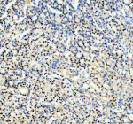 Immunohistochemical staining of SRARP using anti-SRARP antibody. SRARP was detected in a paraffin-embedded section of human thyroid cancer tissue. Heat mediated antigen retrieval was performed in EDTA buffer (pH 8.0, epitope retrieval solution). The tissue section was blocked with 10% goat serum. The tissue section was then incubated with 2 ug/ml rabbit anti-SRARP antibody overnight at 4oC. Peroxidase Conjugated Goat Anti-rabbit IgG was used as secondary antibody and incubated for 30 minutes at 37oC. The tissue section was developed using an HRP secondary and DAB substrate.