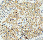 Immunohistochemical staining of SRARP using anti-SRARP antibody. SRARP was detected in a paraffin-embedded section of human bladder cancer tissue. Heat mediated antigen retrieval was performed in EDTA buffer (pH 8.0, epitope retrieval solution). The tissue section was blocked with 10% goat serum. The tissue section was then incubated with 2 ug/ml rabbit anti-SRARP antibody overnight at 4oC. Peroxidase Conjugated Goat Anti-rabbit IgG was used as secondary antibody and incubated for 30 minutes at 37oC. The tissue section was developed using an HRP secondary and DAB substrate.