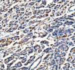 Immunohistochemical staining of APOBEC3C using anti-APOBEC3C antibody. APOBEC3C was detected in a paraffin-embedded section of human pancreas cancer tissue. Heat mediated antigen retrieval was performed in EDTA buffer (pH 8.0, epitope retrieval solution). The tissue section was blocked with 10% goat serum. The tissue section was then incubated with 2 ug/ml rabbit anti-APOBEC3C antibody overnight at 4oC. Peroxidase Conjugated Goat Anti-rabbit IgG was used as secondary antibody and incubated for 30 minutes at 37oC. The tissue section was developed using an HRP secondary and DAB substrate.