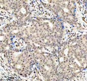Immunohistochemical staining of APOBEC3C using anti-APOBEC3C antibody. APOBEC3C was detected in a paraffin-embedded section of human breast cancer tissue. Heat mediated antigen retrieval was performed in EDTA buffer (pH 8.0, epitope retrieval solution). The tissue section was blocked with 10% goat serum. The tissue section was then incubated with 2 ug/ml rabbit anti-APOBEC3C antibody overnight at 4oC. Peroxidase Conjugated Goat Anti-rabbit IgG was used as secondary antibody and incubated for 30 minutes at 37oC. The tissue section was developed using an HRP secondary and DAB substrate.