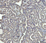 Immunohistochemical staining of NDUFAB1 using anti-NDUFAB1 antibody. NDUFAB1 was detected in a paraffin-embedded section of human thyroid cancer tissue. Heat mediated antigen retrieval was performed in EDTA buffer (pH 8.0, epitope retrieval solution). The tissue section was blocked with 10% goat serum. The tissue section was then incubated with 1:50 rabbit anti-NDUFAB1 antibody overnight at 4oC. Peroxidase Conjugated Goat Anti-rabbit IgG was used as secondary antibody and incubated for 30 minutes at 37oC. The tissue section was developed using an HRP secondary and DAB substrate.