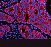 Immunofluorescent staining of PEX1 using anti-PEX1 antibody (red). PEX1 was detected in a paraffin-embedded section of human colon cancer tissue. Heat mediated antigen retrieval was performed in EDTA buffer (pH 8.0, epitope retrieval solution). The tissue section was blocked with 10% goat serum. The tissue section was then incubated with 5 ug/ml rabbit anti-PEX1 antibody overnight at 4oC. Cy3 Conjugated Goat Anti-Rabbit IgG was used as secondary antibody at 1:500 dilution and incubated for 30 minutes at 37oC. The section was counterstained with DAPI nuclear stain (blue). Visualize using a fluorescence microscope and filter sets appropriate for the label used.