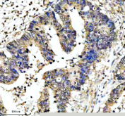Immunohistochemical staining of PEX1 using anti-PEX1 antibody. PEX1 was detected in a paraffin-embedded section of human colon cancer tissue. Heat mediated antigen retrieval was performed in EDTA buffer (pH 8.0, epitope retrieval solution). The tissue section was blocked with 10% goat serum. The tissue section was then incubated with 2 ug/ml rabbit anti-PEX1 antibody overnight at 4oC. Peroxidase Conjugated Goat Anti-rabbit IgG was used as secondary antibody and incubated for 30 minutes at 37oC. The tissue section was developed using an HRP secondary and DAB substrate.