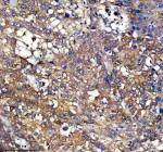 Immunohistochemical staining of PEX11B using anti-PEX11B antibody. PEX11B was detected in a paraffin-embedded section of human liver cancer tissue. Heat mediated antigen retrieval was performed in EDTA buffer (pH 8.0, epitope retrieval solution). The tissue section was blocked with 10% goat serum. The tissue section was then incubated with 1:50 rabbit anti-PEX11B antibody overnight at 4oC. Peroxidase Conjugated Goat Anti-rabbit IgG was used as secondary antibody and incubated for 30 minutes at 37oC. The tissue section was developed using an HRP secondary and DAB substrate.