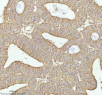Immunohistochemical staining of TNS3 using anti-TNS3 antibody. TNS3 was detected in a paraffin-embedded section of human endometrioid adenocarcinoma tissue. Heat mediated antigen retrieval was performed in EDTA buffer (pH 8.0, epitope retrieval solution). The tissue section was blocked with 10% goat serum. The tissue section was then incubated with 2 ug/ml rabbit anti-TNS3 antibody overnight at 4oC. Peroxidase Conjugated Goat Anti-rabbit IgG was used as secondary antibody and incubated for 30 minutes at 37oC. The tissue section was developed using an HRP secondary and DAB substrate.