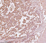 Immunohistochemical staining of TNS3 using anti-TNS3 antibody. TNS3 was detected in a paraffin-embedded section of human liver cancer tissue. Heat mediated antigen retrieval was performed in EDTA buffer (pH 8.0, epitope retrieval solution). The tissue section was blocked with 10% goat serum. The tissue section was then incubated with 2 ug/ml rabbit anti-TNS3 antibody overnight at 4oC. Peroxidase Conjugated Goat Anti-rabbit IgG was used as secondary antibody and incubated for 30 minutes at 37oC. The tissue section was developed using an HRP secondary and DAB substrate.