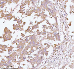 Immunohistochemical staining of TNS3 using anti-TNS3 antibody. TNS3 was detected in a paraffin-embedded section of human liver cancer tissue. Heat mediated antigen retrieval was performed in EDTA buffer (pH 8.0, epitope retrieval solution). The tissue section was blocked with 10% goat serum. The tissue section was then incubated with 2 ug/ml rabbit anti-TNS3 antibody overnight at 4oC. Peroxidase Conjugated Goat Anti-rabbit IgG was used as secondary antibody and incubated for 30 minutes at 37oC. The tissue section was developed using an HRP secondary and DAB substrate.