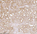 Immunohistochemical staining of TNS3 using anti-TNS3 antibody. TNS3 was detected in a paraffin-embedded section of human prostate adenocarcinoma tissue. Heat mediated antigen retrieval was performed in EDTA buffer (pH 8.0, epitope retrieval solution). The tissue section was blocked with 10% goat serum. The tissue section was then incubated with 2 ug/ml rabbit anti-TNS3 antibody overnight at 4oC. Peroxidase Conjugated Goat Anti-rabbit IgG was used as secondary antibody and incubated for 30 minutes at 37oC. The tissue section was developed using an HRP secondary and DAB substrate.
