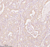 Immunohistochemical staining of TNS3 using anti-TNS3 antibody. TNS3 was detected in a paraffin-embedded section of human colon adenocarcinoma tissue. Heat mediated antigen retrieval was performed in EDTA buffer (pH 8.0, epitope retrieval solution). The tissue section was blocked with 10% goat serum. The tissue section was then incubated with 2 ug/ml rabbit anti-TNS3 antibody overnight at 4oC. Peroxidase Conjugated Goat Anti-rabbit IgG was used as secondary antibody and incubated for 30 minutes at 37oC. The tissue section was developed using an HRP secondary and DAB substrate.