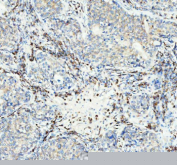 Immunohistochemical staining of Neurokinin 1 Receptor using anti-NKR1 antibody. Neurokinin 1 Receptor was detected in a paraffin-embedded section of human lung cancer tissue. Heat mediated antigen retrieval was performed in EDTA buffer (pH 8.0, epitope retrieval solution). The tissue section was blocked with 10% goat serum. The tissue section was then incubated with 1:50 rabbit anti-NKR1 antibody overnight at 4oC. Peroxidase Conjugated Goat Anti-rabbit IgG was used as secondary antibody and incubated for 30 minutes at 37oC. The tissue section was developed using an HRP secondary and DAB substrate.