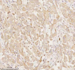 Immunohistochemical staining of ARHGEF7 using anti-ARHGEF7 antibody. ARHGEF7 was detected in a paraffin-embedded section of human lung adenocarcinoma tissue. Heat mediated antigen retrieval was performed in EDTA buffer (pH 8.0, epitope retrieval solution). The tissue section was blocked with 10% goat serum. The tissue section was then incubated with 2 ug/ml rabbit anti-ARHGEF7 antibody overnight at 4oC. Peroxidase Conjugated Goat Anti-rabbit IgG was used as secondary antibody and incubated for 30 minutes at 37oC. The tissue section was developed using an HRP secondary and DAB substrate.