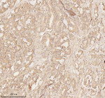 Immunohistochemical staining of ARHGEF7 using anti-ARHGEF7 antibody. ARHGEF7 was detected in a paraffin-embedded section of human prostate adenocarcinoma tissue. Heat mediated antigen retrieval was performed in EDTA buffer (pH 8.0, epitope retrieval solution). The tissue section was blocked with 10% goat serum. The tissue section was then incubated with 2 ug/ml rabbit anti-ARHGEF7 antibody overnight at 4oC. Peroxidase Conjugated Goat Anti-rabbit IgG was used as secondary antibody and incubated for 30 minutes at 37oC. The tissue section was developed using an HRP secondary and DAB substrate.