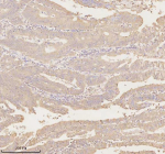Immunohistochemical staining of ARHGEF7 using anti-ARHGEF7 antibody. ARHGEF7 was detected in a paraffin-embedded section of human rectum adenocarcinoma tissue. Heat mediated antigen retrieval was performed in EDTA buffer (pH 8.0, epitope retrieval solution). The tissue section was blocked with 10% goat serum. The tissue section was then incubated with 2 ug/ml rabbit anti-ARHGEF7 antibody overnight at 4oC. Peroxidase Conjugated Goat Anti-rabbit IgG was used as secondary antibody and incubated for 30 minutes at 37oC. The tissue section was developed using an HRP secondary and DAB substrate.