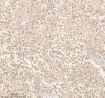 Immunohistochemical staining of ARHGEF7 using anti-ARHGEF7 antibody. ARHGEF7 was detected in a paraffin-embedded section of human testicular seminoma tissue. Heat mediated antigen retrieval was performed in EDTA buffer (pH 8.0, epitope retrieval solution). The tissue section was blocked with 10% goat serum. The tissue section was then incubated with 2 ug/ml rabbit anti-ARHGEF7 antibody overnight at 4oC. Peroxidase Conjugated Goat Anti-rabbit IgG was used as secondary antibody and incubated for 30 minutes at 37oC. The tissue section was developed using an HRP secondary and DAB substrate.