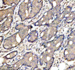 Immunohistochemical staining of PLAAT4 using anti-PLAAT4 antibody. PLAAT4 was detected in a paraffin-embedded section of human breast cancer tissue. Heat mediated antigen retrieval was performed in EDTA buffer (pH 8.0, epitope retrieval solution). The tissue section was blocked with 10% goat serum. The tissue section was then incubated with 2 ug/ml rabbit anti-PLAAT4 antibody overnight at 4oC. Peroxidase Conjugated Goat Anti-rabbit IgG was used as secondary antibody and incubated for 30 minutes at 37oC. The tissue section was developed using an HRP secondary and DAB substrate.