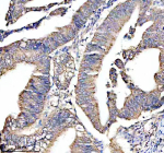 Immunohistochemical staining of PLAAT4 using anti-PLAAT4 antibody. PLAAT4 was detected in a paraffin-embedded section of human colon cancer tissue. Heat mediated antigen retrieval was performed in EDTA buffer (pH 8.0, epitope retrieval solution). The tissue section was blocked with 10% goat serum. The tissue section was then incubated with 2 ug/ml rabbit anti-PLAAT4 antibody overnight at 4oC. Peroxidase Conjugated Goat Anti-rabbit IgG was used as secondary antibody and incubated for 30 minutes at 37oC. The tissue section was developed using an HRP secondary and DAB substrate.