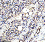 Immunohistochemical staining of PLAAT4 using anti-PLAAT4 antibody. PLAAT4 was detected in a paraffin-embedded section of human pancreas cancer tissue. Heat mediated antigen retrieval was performed in EDTA buffer (pH 8.0, epitope retrieval solution). The tissue section was blocked with 10% goat serum. The tissue section was then incubated with 2 ug/ml rabbit anti-PLAAT4 antibody overnight at 4oC. Peroxidase Conjugated Goat Anti-rabbit IgG was used as secondary antibody and incubated for 30 minutes at 37oC. The tissue section was developed using an HRP secondary and DAB substrate.