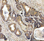 Immunohistochemical staining of ABCG5 using anti-ABCG5 antibody. ABCG5 was detected in a paraffin-embedded section of human colon cancer tissue. Heat mediated antigen retrieval was performed in EDTA buffer (pH 8.0, epitope retrieval solution). The tissue section was blocked with 10% goat serum. The tissue section was then incubated with 2 ug/ml rabbit anti-ABCG5 antibody overnight at 4oC. Peroxidase Conjugated Goat Anti-rabbit IgG was used as secondary antibody and incubated for 30 minutes at 37oC. The tissue section was developed using an HRP secondary and DAB substrate.