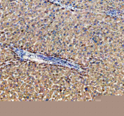 Immunohistochemical staining of ABCG5 using anti-ABCG5 antibody. ABCG5 was detected in a paraffin-embedded section of human liver cancer tissue. Heat mediated antigen retrieval was performed in EDTA buffer (pH 8.0, epitope retrieval solution). The tissue section was blocked with 10% goat serum. The tissue section was then incubated with 2 ug/ml rabbit anti-ABCG5 antibody overnight at 4oC. Peroxidase Conjugated Goat Anti-rabbit IgG was used as secondary antibody and incubated for 30 minutes at 37oC. The tissue section was developed using an HRP secondary and DAB substrate.