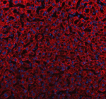 Immunofluorescent staining of ABCG5 using anti-ABCG5 antibody (red). ABCG5 was detected in a paraffin-embedded section of human liver cancer tissue. Heat mediated antigen retrieval was performed in EDTA buffer (pH 8.0, epitope retrieval solution). The tissue section was blocked with 10% goat serum. The tissue section was then incubated with 5 ug/ml rabbit anti-ABCG5 antibody overnight at 4oC. Cy3 Conjugated Goat Anti-Rabbit IgG was used as secondary antibody at 1:500 dilution and incubated for 30 minutes at 37oC. The section was counterstained with DAPI nuclear stain (blue). Visualize using a fluorescence microscope and filter sets appropriate for the label used.
