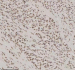 Immunohistochemical staining of NUPR1 using anti-NUPR1 antibody. NUPR1 was detected in a paraffin-embedded section of human lung cancer tissue. Heat mediated antigen retrieval was performed in EDTA buffer (pH 8.0, epitope retrieval solution). The tissue section was blocked with 10% goat serum. The tissue section was then incubated with 2 ug/ml rabbit anti-NUPR1 antibody overnight at 4oC. Peroxidase Conjugated Goat Anti-rabbit IgG was used as secondary antibody and incubated for 30 minutes at 37oC. The tissue section was developed using an HRP secondary and DAB substrate.