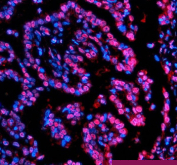 Immunofluorescent staining of NUPR1 using anti-NUPR1 antibody (red). NUPR1 was detected in a paraffin-embedded section of human lung cancer tissue. Heat mediated antigen retrieval was performed in EDTA buffer (pH 8.0, epitope retrieval solution). The tissue section was blocked with 10% goat serum. The tissue section was then incubated with 5 ug/ml rabbit anti-NUPR1 antibody overnight at 4oC. Cy3 Conjugated Goat Anti-Rabbit IgG was used as secondary antibody at 1:500 dilution and incubated for 30 minutes at 37oC. The section was counterstained with DAPI nuclear stain (blue). Visualize using a fluorescence microscope and filter sets appropriate for the label used.