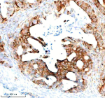 Immunohistochemical staining of STAMBP using anti-STAMBP antibody. STAMBP was detected in a paraffin-embedded section of human ovarian cancer tissue. Heat mediated antigen retrieval was performed in EDTA buffer (pH 8.0, epitope retrieval solution). The tissue section was blocked with 10% goat serum. The tissue section was then incubated with 2 ug/ml rabbit anti-STAMBP antibody overnight at 4oC. Peroxidase Conjugated Goat Anti-rabbit IgG was used as secondary antibody and incubated for 30 minutes at 37oC. The tissue section was developed using an HRP secondary and DAB substrate.