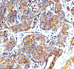 Immunohistochemical staining of STAMBP using anti-STAMBP antibody. STAMBP was detected in a paraffin-embedded section of human cervical cancer tissue. Heat mediated antigen retrieval was performed in EDTA buffer (pH 8.0, epitope retrieval solution). The tissue section was blocked with 10% goat serum. The tissue section was then incubated with 2 ug/ml rabbit anti-STAMBP antibody overnight at 4oC. Peroxidase Conjugated Goat Anti-rabbit IgG was used as secondary antibody and incubated for 30 minutes at 37oC. The tissue section was developed using an HRP secondary and DAB substrate.