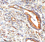 Immunohistochemical staining of STAMBP using anti-STAMBP antibody. STAMBP was detected in a paraffin-embedded section of human rectal adenocarcinoma tissue. Heat mediated antigen retrieval was performed in EDTA buffer (pH 8.0, epitope retrieval solution). The tissue section was blocked with 10% goat serum. The tissue section was then incubated with 2 ug/ml rabbit anti-STAMBP antibody overnight at 4oC. Peroxidase Conjugated Goat Anti-rabbit IgG was used as secondary antibody and incubated for 30 minutes at 37oC. The tissue section was developed using an HRP secondary and DAB substrate.