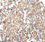 Immunohistochemical staining of STAMBP using anti-STAMBP antibody. STAMBP was detected in a paraffin-embedded section of human testis cancer tissue. Heat mediated antigen retrieval was performed in EDTA buffer (pH 8.0, epitope retrieval solution). The tissue section was blocked with 10% goat serum. The tissue section was then incubated with 2 ug/ml rabbit anti-STAMBP antibody overnight at 4oC. Peroxidase Conjugated Goat Anti-rabbit IgG was used as secondary antibody and incubated for 30 minutes at 37oC. The tissue section was developed using an HRP secondary and DAB substrate.