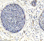 Immunohistochemical staining of using anti-ARL2 antibody. was detected in a paraffin-embedded section of human cervical cancer tissue. Heat mediated antigen retrieval was performed in EDTA buffer (pH 8.0, epitope retrieval solution). The tissue section was blocked with 10% goat serum. The tissue section was then incubated with 2 ug/ml rabbit anti-ARL2 antibody overnight at 4oC. Peroxidase Conjugated Goat Anti-rabbit IgG was used as secondary antibody and incubated for 30 minutes at 37oC. The tissue section was developed using an HRP secondary and DAB substrate.