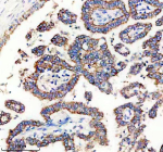 Immunohistochemical staining of TIMM9 using anti-TIMM9 antibody. TIMM9 was detected in a paraffin-embedded section of human lung cancer tissue. Heat mediated antigen retrieval was performed in EDTA buffer (pH 8.0, epitope retrieval solution). The tissue section was blocked with 10% goat serum. The tissue section was then incubated with 2 ug/ml rabbit anti-TIMM9 antibody overnight at 4oC. Peroxidase Conjugated Goat Anti-rabbit IgG was used as secondary antibody and incubated for 30 minutes at 37oC. The tissue section was developed using an HRP secondary and DAB substrate.